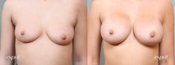 Breast Augmentation 5108, Front