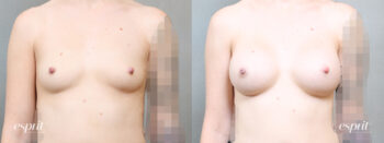 Breast Augmentation 5113, Front