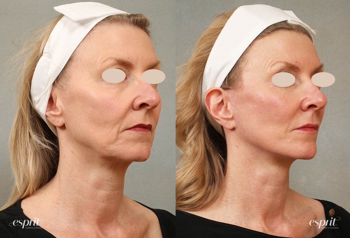 An Introduction to Facelifts and Neck Lifts